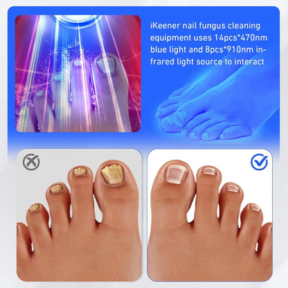 Wireless, Nail Fungus, Laser Device, Infrared, Blue Light, Anti-Fungal