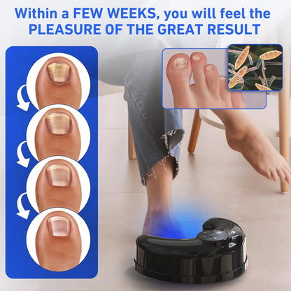Wireless, Nail Fungus, Laser Device, Infrared, Blue Light, Anti-Fungal